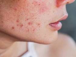 soigner l'acné avec les produits forever